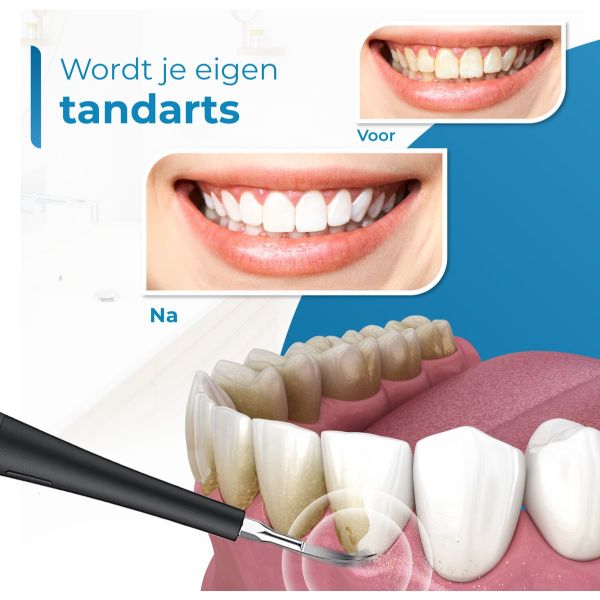Professionele Tandsteen Verwijderaar – 5 standen – Inclusief Tandarts Set – 3 opzetstukken